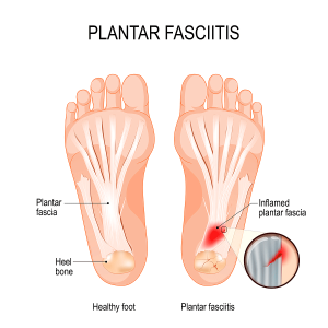 diagram of healthy foot next to diagram of foot with plantar fasciitis